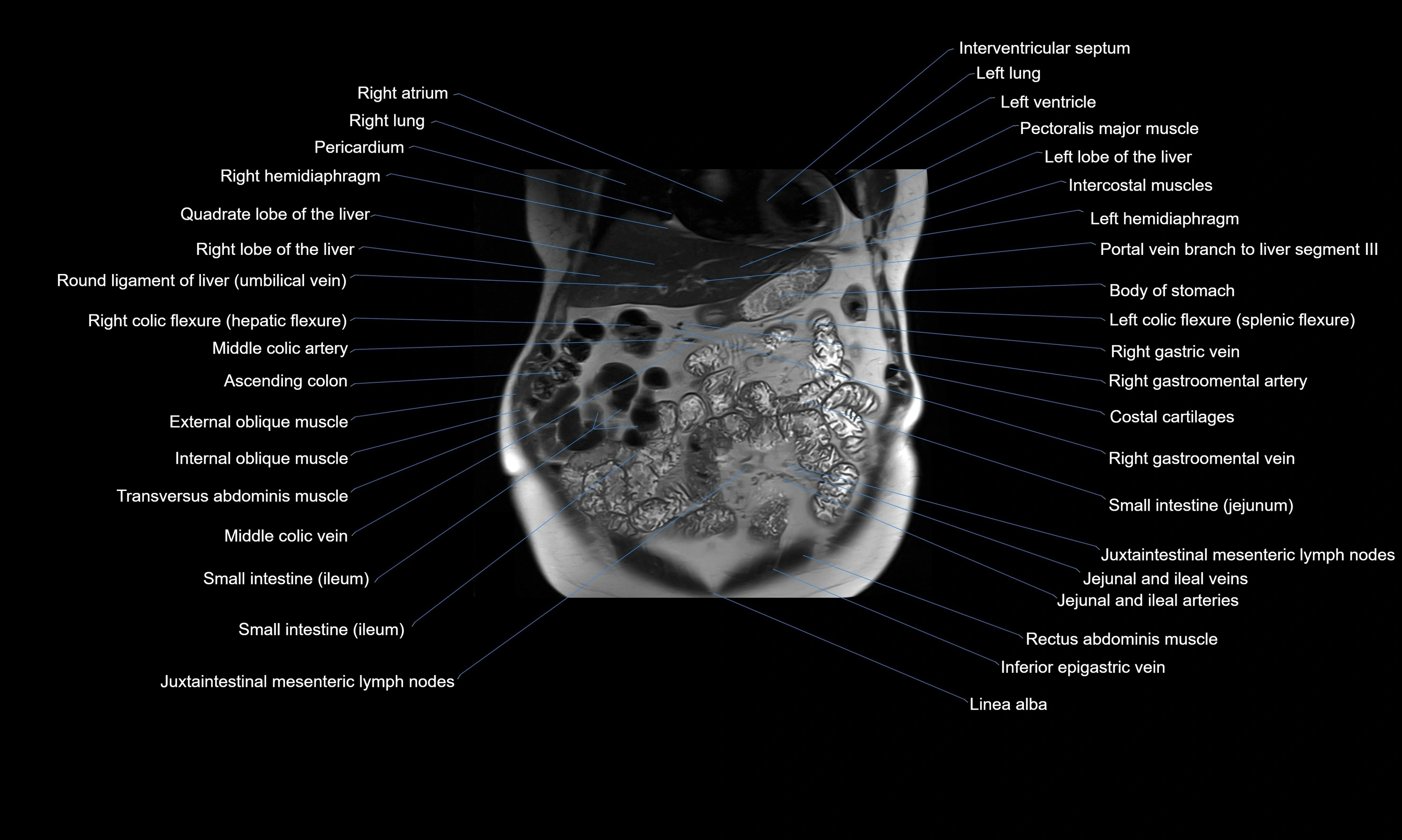 MRI Abdomen axial cross sectional anatomy radiology  image-img-00001-00017.webp